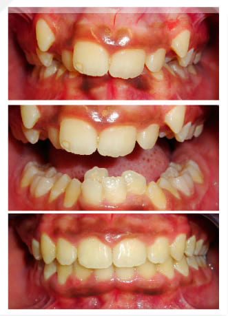Before and After | Mount Albert Orthodontic Specialists