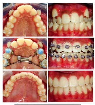 Before and After | Mount Albert Orthodontic Specialists